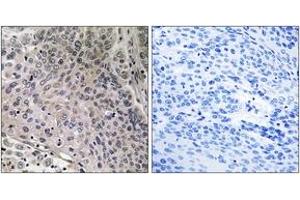 Immunohistochemistry analysis of paraffin-embedded human breast carcinoma tissue, using TEBP (Ab-113) Antibody. (NKX2-1 antibody  (AA 79-128))