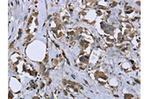 The image on the left is immunohistochemistry of paraffin-embedded Human breast cancer tissue using ABIN7130317(MYL12B Antibody) at dilution 1/20, on the right is treated with fusion protein. (MYL12B antibody)