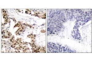 Immunohistochemical analysis of paraffin-embedded human breast carcinoma tissue using NF-κB p105/p50 (phospho-Ser893) antibody (E011018). (NFKB1 antibody  (pSer893))