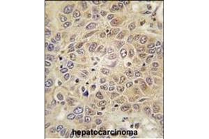 Forlin-fixed and paraffin-embedded hun hepatocarcino tissue reacted with RS antibody (C-term) (ABIN392313 and ABIN2841964) , which was peroxidase-conjugated to the secondary antibody, followed by DAB staining. (Mars (MARS) (AA 872-899), (C-Term) antibody)