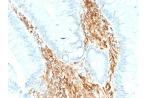 Formalin-fixed, paraffin-embedded human Colon Carcinoma stained with Vimentin Rabbit Recombinant Monoclonal Antibody (VIM/1937R). (Recombinant Vimentin antibody)