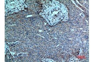 Immunohistochemistry (IHC) analysis of paraffin-embedded Human Breast Cancer, antibody was diluted at 1:100. (PLA2G4A antibody  (N-Term))
