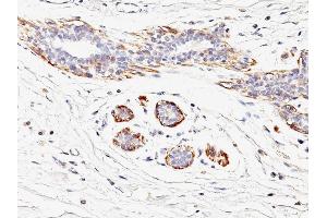 Formalin-fixed, paraffin-embedded human Breast Carcinoma stained with SM-MHC Mouse Monoclonal Antibody (MYH11/923). (MYH11 antibody)