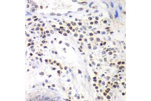 Immunohistochemistry of paraffin-embedded human colon using SMARCA4 antibody (ABIN6290438) at dilution of 1:100 (40x lens). (SMARCA4 antibody)