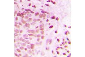 Immunohistochemical analysis of ATRIP staining in human breast cancer formalin fixed paraffin embedded tissue section. (ATRIP antibody  (N-Term))