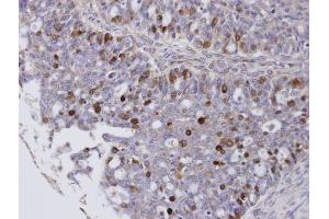 IHC-P Image Immunohistochemical analysis of paraffin-embedded human ovarian cancer, using FOXM1, antibody at 1:100 dilution. (FOXM1 antibody  (C-Term))