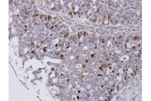 IHC-P Image Immunohistochemical analysis of paraffin-embedded human ovarian cancer, using FOXM1, antibody at 1:100 dilution. (FOXM1 antibody  (C-Term))