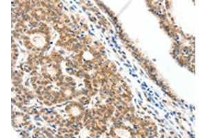 The image on the left is immunohistochemistry of paraffin-embedded Human thyroid cancer tissue using ABIN7192279(SCN2A Antibody) at dilution 1/25, on the right is treated with synthetic peptide.