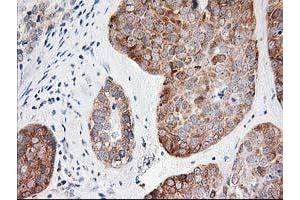 Immunohistochemical staining of paraffin-embedded Adenocarcinoma of Human breast tissue using anti-LCMT1 mouse monoclonal antibody. (LCMT1 antibody)