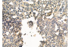 ABIN6266348 and ABIN6276701 at 1/100 staining Human ovarian cancer and adjacent normal tissues by IHC-P.