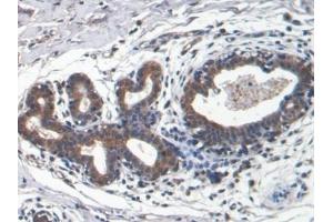 Detection of LEP in Human Breast cancer Tissue using Monoclonal Antibody to Leptin (LEP) (Leptin antibody  (AA 22-167))