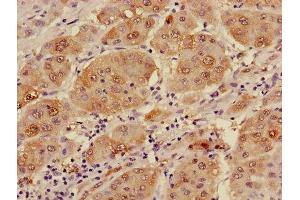 Immunohistochemistry of paraffin-embedded human liver cancer using ABIN7143645 at dilution of 1:100 (ADH1B antibody  (AA 2-375))