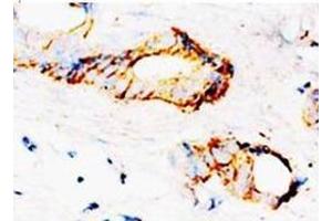 Immunohistochemical analysis of paraffin-embedded mammary cancer sections, staining SAMDC in cytoplasm, DAB Chromogenic reaction (AMD1 antibody  (C-Term))