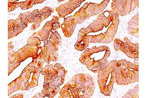 Formalin-fixed, paraffin-embedded human Colon Carcinoma stained with Multi Cytokeratin Mouse Monoclonal Antibody (C11). (KRT4, KRT5, KRT6, KRT8, KRT10, KRT13, KRT18 antibody)