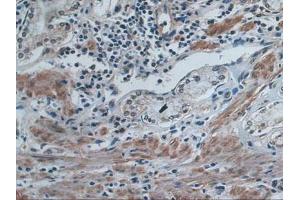 IHC-P analysis of Human Stomach Cancer Tissue, with DAB staining. (IDE antibody  (AA 753-973))