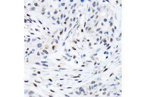 Immunohistochemistry of paraffin-embedded human esophageal cancer using TFE3 Rabbit mAb (ABIN1683323, ABIN3015205, ABIN3015206 and ABIN7101320) at dilution of 1:100 (40x lens). (TFE3 antibody)