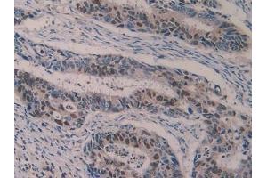 Detection of 5-LO in Human Colorectal cancer Tissue using Polyclonal Antibody to 5-Lipoxygenase (5-LO) (ALOX5 antibody  (AA 461-671))