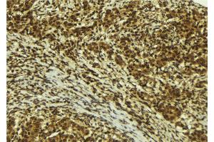 ABIN6272493 at 1/100 staining Human breast cancer tissue by IHC-P. (ZNF295 antibody  (N-Term))