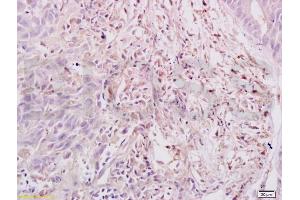 Formalin-fixed and paraffin embedded human gastric carcinoma labeled with Anti-Dnmt3a Polyclonal Antibody, Unconjugated (ABIN669336) at 1:200, followed by conjugation to the secondary antibody and DAB staining (DNMT3A antibody  (AA 26-100))