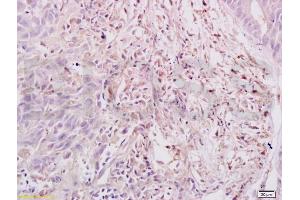 Formalin-fixed and paraffin embedded human gastric carcinoma labeled with Anti-Dnmt3a Polyclonal Antibody, Unconjugated (ABIN669336) at 1:200, followed by conjugation to the secondary antibody and DAB staining