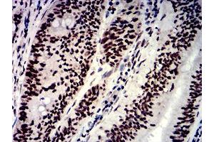 Immunohistochemical analysis of paraffin-embedded rectum cancer tissues using NAGR1 mouse mAb with DAB staining. (HNRNPM antibody  (AA 17-161))