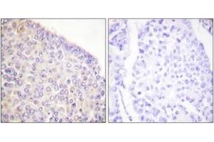 Immunohistochemistry analysis of paraffin-embedded human breast carcinoma, using SYK (Phospho-Tyr525) Antibody. (SYK antibody  (pTyr525))