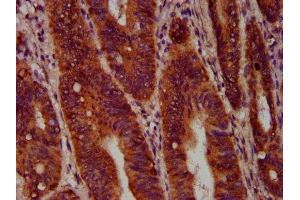 IHC image of ABIN7168647 diluted at 1:400 and staining in paraffin-embedded human colon cancer performed on a Leica BondTM system. (SEC14L2 antibody  (AA 233-358))