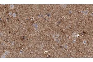 ABIN6277785 at 1/100 staining Human brain cancer tissue by IHC-P. (Doublecortin antibody  (pSer335))