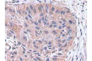DAB staining on IHC-P; Samples: Human Lung cancer Tissue (pPLA2 antibody  (AA 16-148))