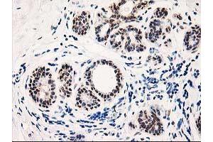 Immunohistochemical staining of paraffin-embedded Human breast tissue using anti-TP53I3 mouse monoclonal antibody. (TP53I3 antibody)