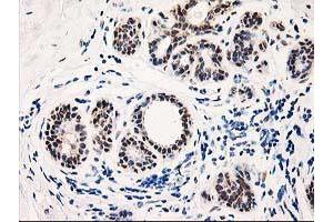 Immunohistochemical staining of paraffin-embedded Human breast tissue using anti-TP53I3 mouse monoclonal antibody. (TP53I3 antibody)