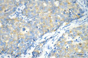 Immunohistochemistry was performed on paraffin-embedded human breast carcinoma using G3BP1 antibody (ABIN7798815), 1:200).