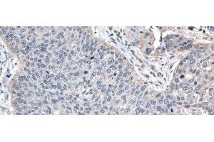 Immunohistochemistry of paraffin-embedded Human lung cancer tissue using ZFAND5 Polyclonal Antibody at dilution of 1:35(x200) (ZFAND5 antibody)