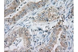 Immunohistochemical staining of paraffin-embedded Adenocarcinoma of Human ovary tissue using anti-CD5 mouse monoclonal antibody. (CD5 antibody)