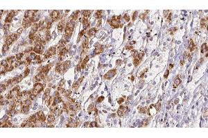 ABIN6278126 at 1/100 staining Human liver cancer tissue by IHC-P. (SEMA4D/CD100 antibody  (C-Term))
