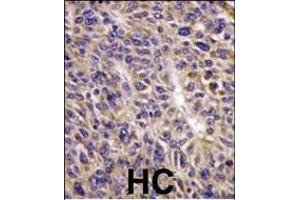 Formalin-fixed and paraffin-embedded human hepatocarcinoma reacted with UBE2L6 Antibody (N-term) (ABIN1882146 and ABIN2839155) , which was peroxidase-conjugated to the secondary antibody, followed by DAB staining. (UBE2L6 antibody  (N-Term))