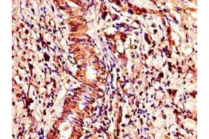 Immunohistochemistry of paraffin-embedded human gastric cancer using ABIN7148300 at dilution of 1:100 (COMMD1 antibody  (AA 2-190))