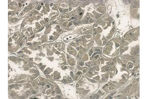 ABIN6256977 and ABIN6275032 at 1/100 staining human renal cell carcinoma by IHC-P. (C1S antibody  (C-Term))