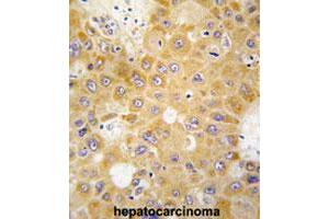 Formalin-fixed and paraffin-embedded human hepatocarcinomareacted with APH1A polyclonal antibody , which was peroxidase-conjugated to the secondary antibody, followed by AEC staining.