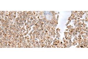 Immunohistochemistry of paraffin-embedded Human ovarian cancer tissue using GLYAT Polyclonal Antibody at dilution of 1:50(x200) (GLYAT antibody)