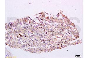 Formalin-fixed and paraffin embedded human cervical carcinoma tissue labeled with Anti-CYP24A1 Polyclonal Antibody, Unconjugated (ABIN750838) at 1:200 followed by conjugation to the secondary antibody and DAB staining (CYP24A1 antibody  (AA 351-450))