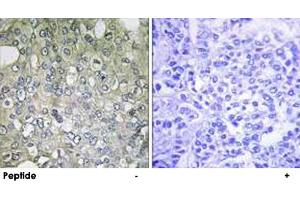 Immunohistochemistry analysis of paraffin-embedded human breast carcinoma tissue using ADRA1D polyclonal antibody .