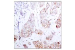 Immunohistochemical analysis of paraffin-embedded human breast carcinoma tissue using Raf-1 (Ab-259) antibody (E021006). (RAF1 antibody)