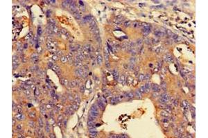 Immunohistochemistry of paraffin-embedded human colon cancer using ABIN7160778 at dilution of 1:100 (NMI antibody  (AA 62-202))