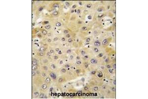 Formalin-fixed and paraffin-embedded human hepatocarcinoma tissue reacted with BP antibody (C-term) (ABIN391801 and ABIN2841655) , which was peroxidase-conjugated to the secondary antibody, followed by DAB staining. (CXCL7 antibody  (C-Term))