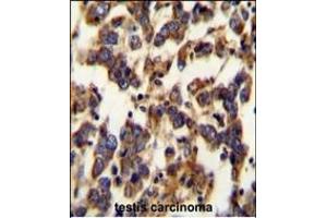BSCL2 Antibody (N-term) (ABIN654071 and ABIN2843967) immunohistochemistry analysis in formalin fixed and paraffin embedded human testis carcinoma followed by peroxidase conjugation of the secondary antibody and DAB staining. (BSCL2 antibody  (N-Term))