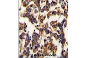 BSCL2 Antibody (N-term) (ABIN654071 and ABIN2843967) immunohistochemistry analysis in formalin fixed and paraffin embedded human testis carcinoma followed by peroxidase conjugation of the secondary antibody and DAB staining.