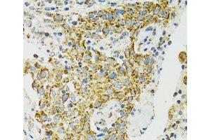 Immunohistochemistry of paraffin-embedded Human lung cancer using HSPA9 Polyclonal Antibody at dilution of 1:100 (40x lens). (HSPA9 antibody)