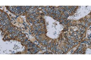 Immunohistochemistry of paraffin-embedded Human colon cancer using NDUFA5 Polyclonal Antibody at dilution of 1:60 (NDUFA5 antibody)