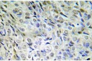 Immunohistochemistry (IHC) analyzes of p-beta-catenin (pSer33/pSer37/pThr41) antibody in paraffin-embedded human lung adenocarcinoma tissue. (CTNNB1 antibody  (pSer33, pSer37, pThr41))
